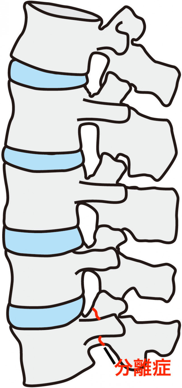 腰椎の画像